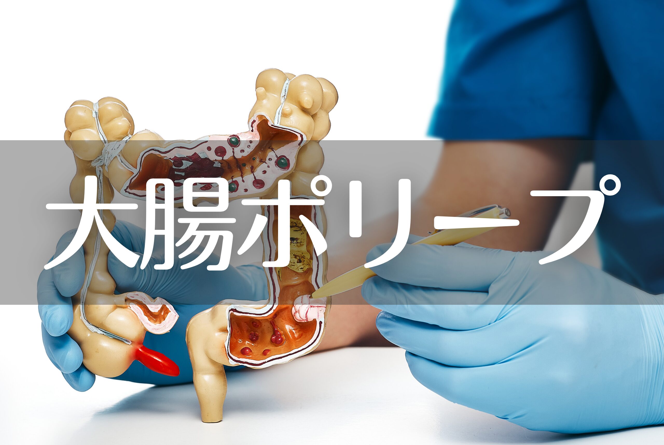 大腸ポリー ブ