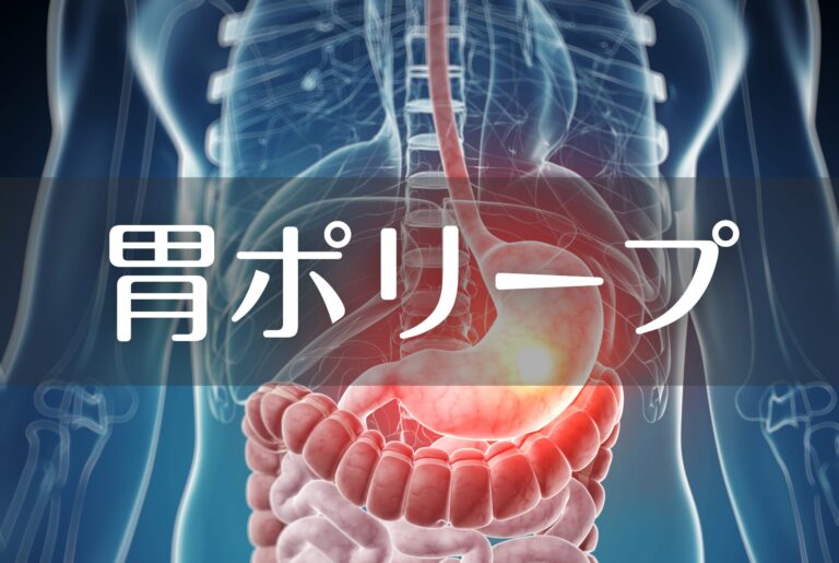 胃ポリープ